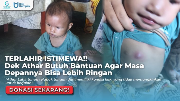 TERLAHIR TAK SEMPURNA!! Bantu Ringankan Masa Depan Dek Athar