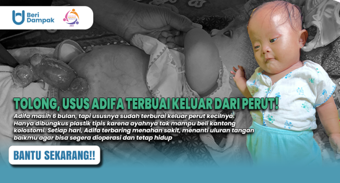Usus Keluar Melalui Perut, Bantu Adhifa Berjuang Dan Mendapat Penanganan Layak