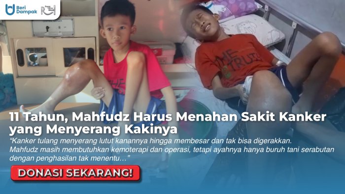 Kanker Tulang Ganas Bikin Kaki Mahfudz Membesar dan Tak Bisa Bergerak. Bantu Ia Sembuh