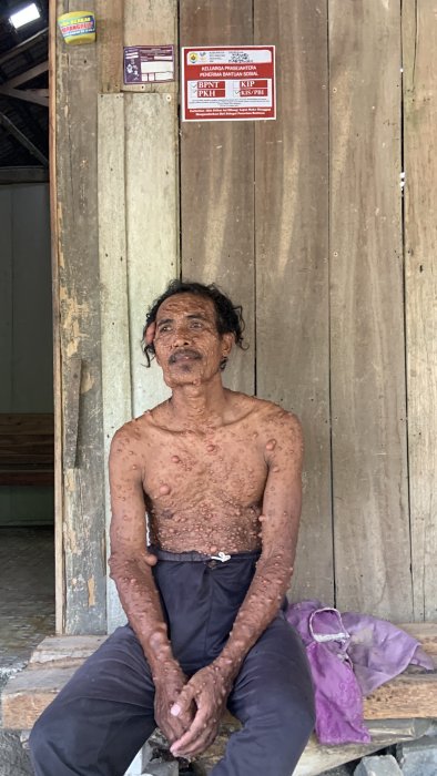 Benjolan Terus Tumbuh di Tubuhnya, Pak Karminto Tak Mampu Berobat dan Masih Harus Merawat Ibunya