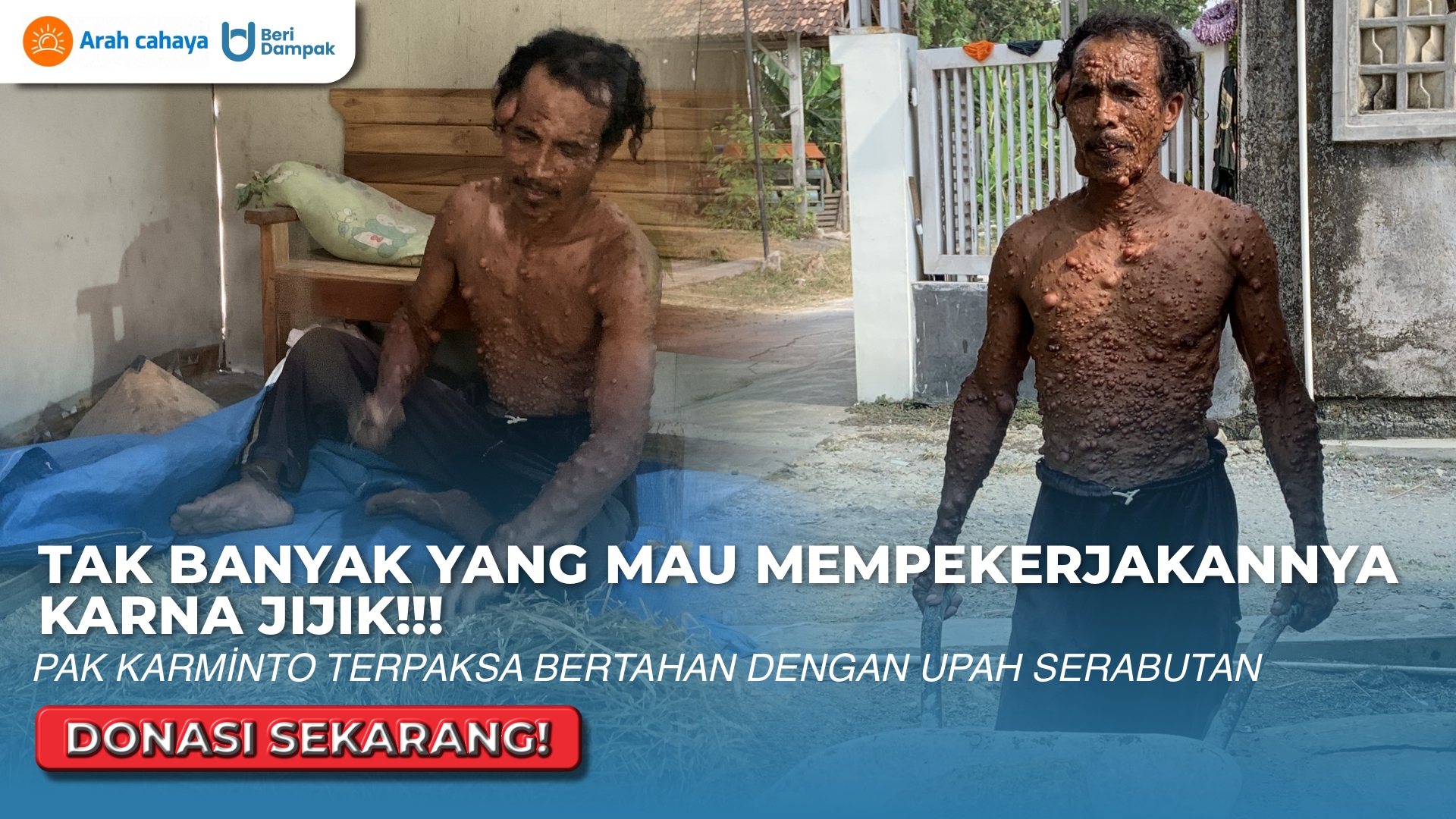 Benjolan Terus Tumbuh di Tubuhnya, Pak Karminto Tak Mampu Berobat dan Masih Harus Merawat Ibunya