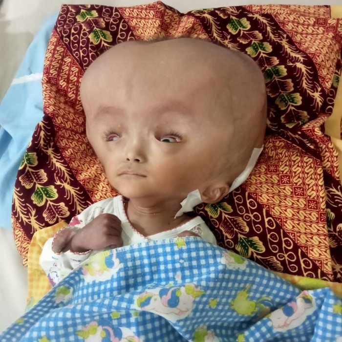 Kepala Kenzie Terus Membesar Meski Sudah 3 Kali Operasi, Bantu Ia Bertahan Melawan Hidrosefalus