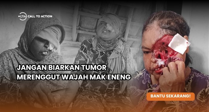 Berjuang Melawan Tumor Wajah, Mak Eneng Terancam Kehilangan Penglihatan Sepenuhnya